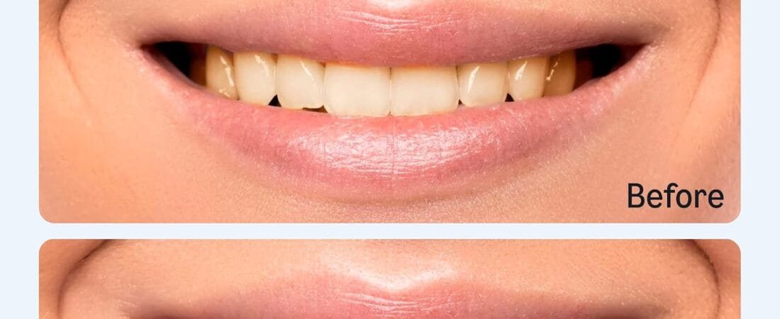 10 Day Teeth Whitening Strips Kit
